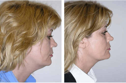 Wheres The Incision For A Neck Lift Plymouth Meeting Neck Lift
