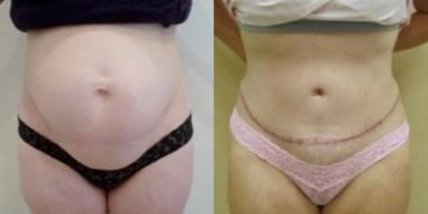 How Soon Can I Get a Tummy Tuck After Childbirth?: Laughlin