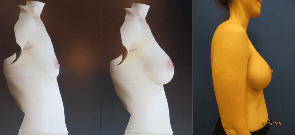 breast-augmentation-results_philadelphia