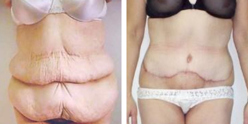 Body Lift Surgery, Remove Sagging or Drooping Skin