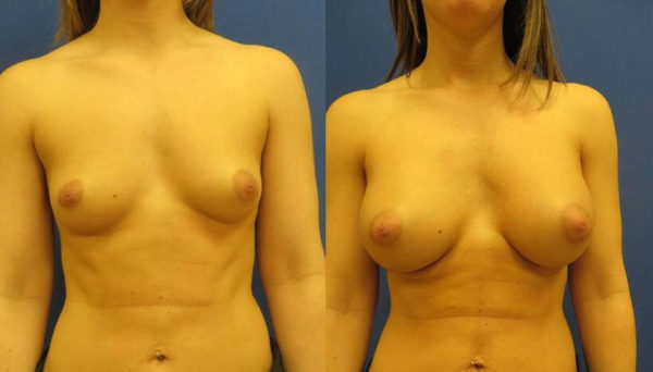 How Much Does Breast Augmentation Cost Plymouth Meeting