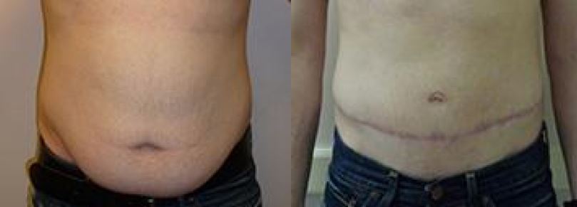 Liposuction vs. Smartlipo™