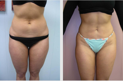 What are the Benefits of Liposuction? - The Pennsylvania Centre for Plastic  Surgery