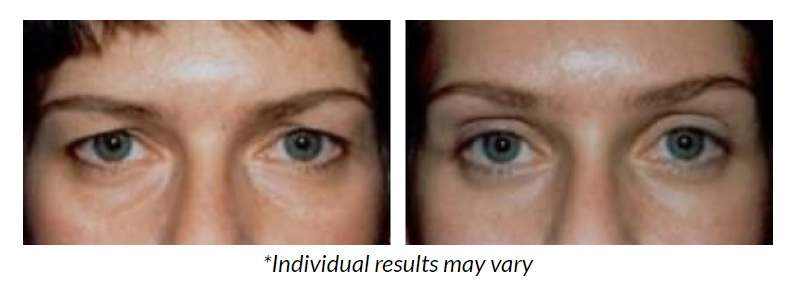 Why Choose a Brow Lift Over Non-Surgical Options?