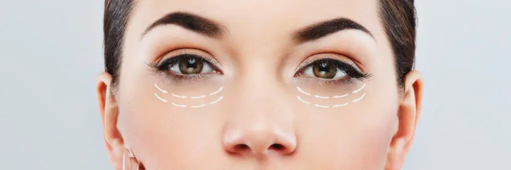 Blepharoplasty
