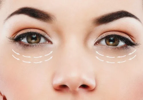 Blepharoplasty